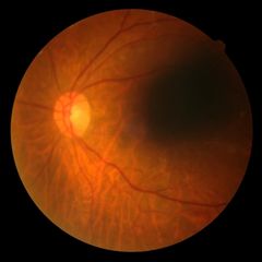 RETİNA YIRTILMASI BEKLEMEDİĞİMİZ YERDEN YEDİĞİMİZ BİR GOL GİBİ! 